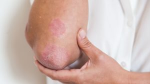Este mal no solo afecta la piel, diversos estudios han demostrado que las personas con psoriasis pueden ver afectada su calidad de vida
