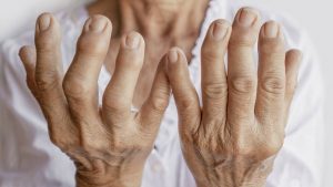 Un fármaco para tratar la artritis salva vidas contra el covid