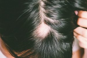 ¿Qué es la alopecia o Pérdida del cabello?