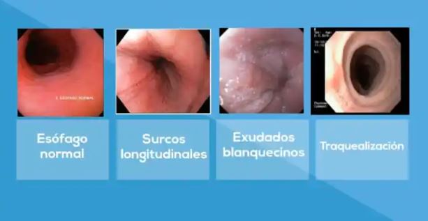 La EoE es una enfermedad crónica, localizada en el esófago, que, en situaciones graves, impide incluso comer sólido.